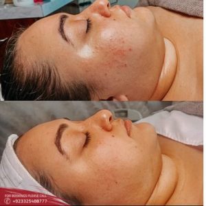oxygen facial before and after