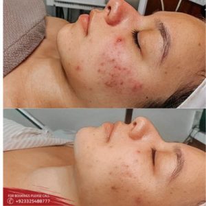 oxygen facial cost in Islamabad