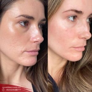 Skin Rejuvenation Treatments in Islamabad, Rawalpindi & Pakistan