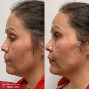 Thread Lift Treatment Pakistan