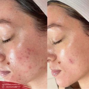 Microneedling treatment before after