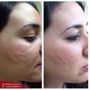 Microneedling treatment cost in Islamabad