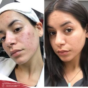 Results of Microneedling treatment
