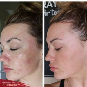 Microneedling with Prp Therapy before after