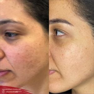 Microneedling with Prp Therapy cost in Islamabad