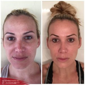 results of Microneedling with Prp Therapy