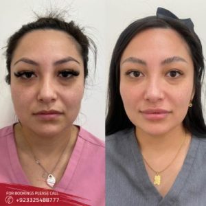 Filler Injections with PRP Islamabad Pakistan & Rawalpindi