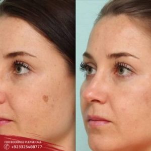 Carbon Laser Peel before after