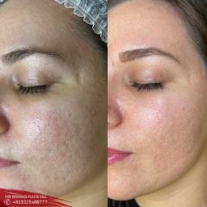 Carbon Laser Peel cost is Islamabad