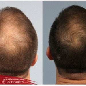 Filler Injections with PRP in Pakistan