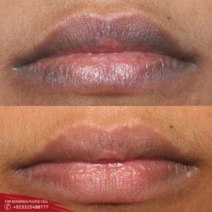 Smoker Lips Treatment before and after