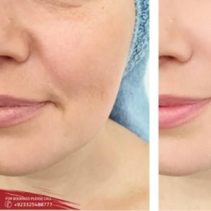 Smoker Lips Treatment cost in Islamabad