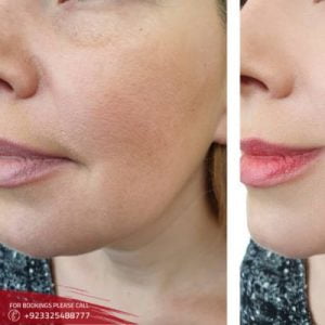 Results of Smoker Lips Treatment