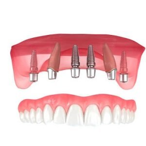 Recovery after dental implant surgery