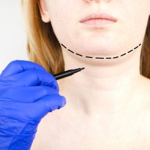 What are the double chin removal solutions?