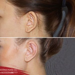 ear reshaping before after