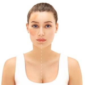 What’s the difference between hyperpigmentation and skin tone?