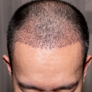 Is it common for my scalp to itch following a hair transplant?