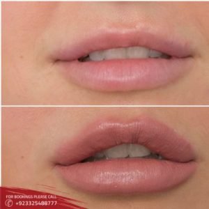 lip reducation cost in Islamabad