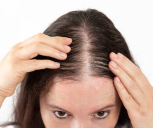 What is the permanent treatment for hair loss?