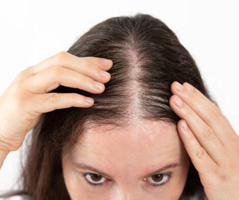 What is the permanent treatment for hair loss?hair loss treatment