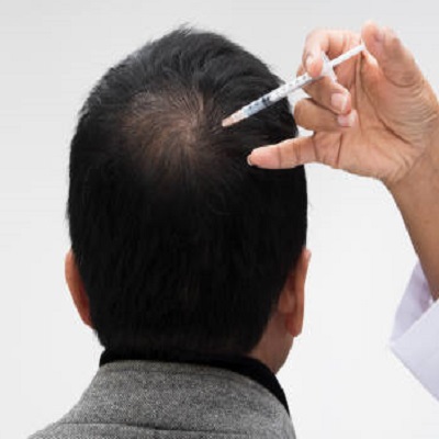 Suffering from hair loss, Try PRP hair treatment