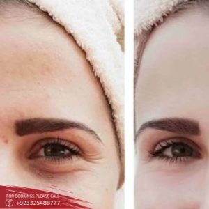 Eyelid Surgery – Blepharoplasty in Islamabad & Pakistan