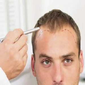 Is it possible to experience hair loss in the later stages after a hair transplant?