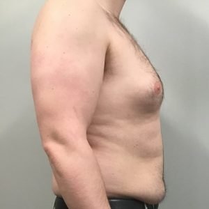 How Much Does Gynecomastia Surgery Cost in Pakistan