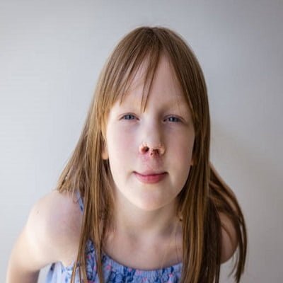 Early Detection and Intervention of cleft lip and palate | cleft lip