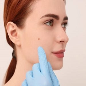 Common Methods of Birthmark Removal: Pros and Cons