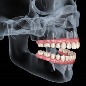 How Can I Speed Up Recovery After Jaw Surgery?