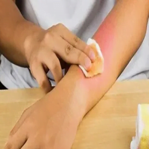 Addressing Common Misconceptions About Burn Reconstructive Surgery
