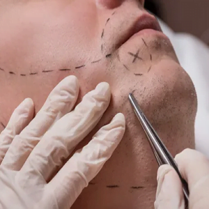 Frequently Asked Questions About Beard Hair Transplants
