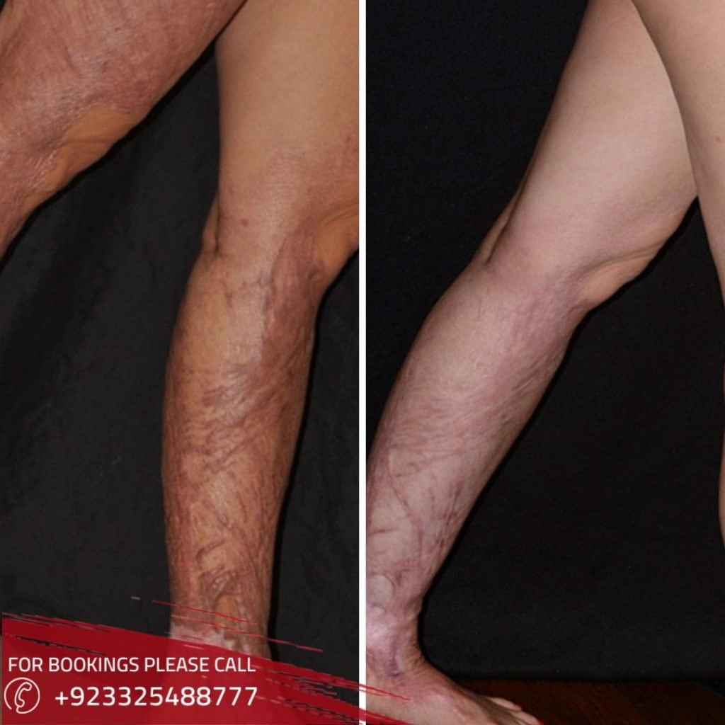Burn & Reconstruction Surgery Clinic In Islamabad - SKN Cosmetic ...