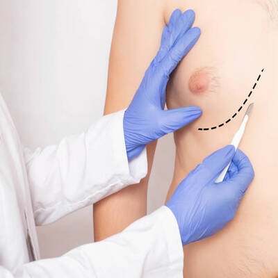is gynecomastia just a cosmetic issue? | gynecomastia