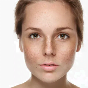 Medical Treatments for Hyperpigmentation: What to Expect