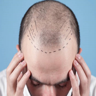 How much does 1500 hair grafts cost in Pakistan? | hair transplant