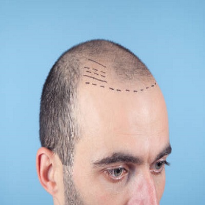 Why consultation for the hair transplant process is important? | hair transplant