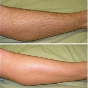 Laser Half Legs Hair Removal Cost in Islamabad