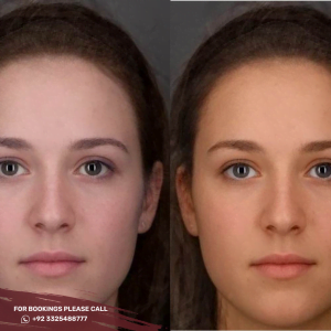 Skin Whitening Treatment before after results