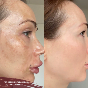 Skin Whitening Treatment in Islamabad, Rawalpindi & Pakistan