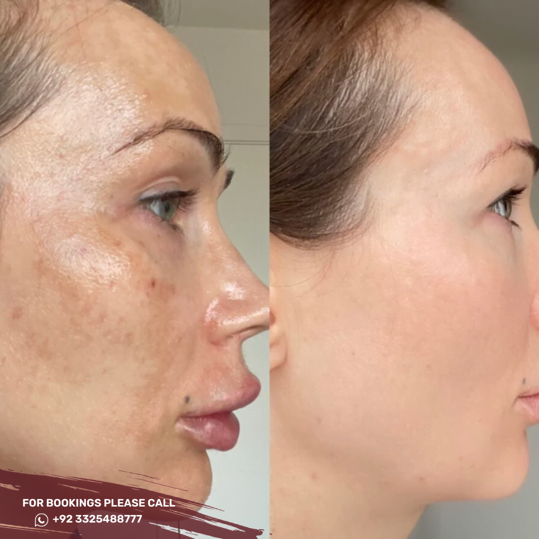 Best Skin Whitening in Islamabad, Rawalpindi & Pakistan Lightening Cost