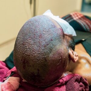 Stages Of Hair Transplant in Islamabad