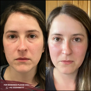 before after results of skin whitening treatment in pakistan