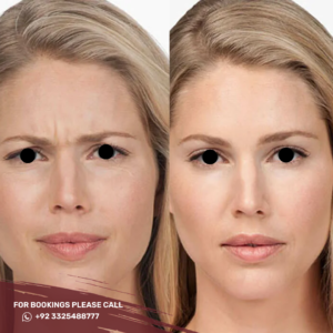 botox injection before after results in islamabad