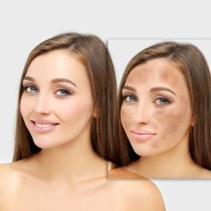 Hyperpigmentation Treatment Tips for Flawless Skin