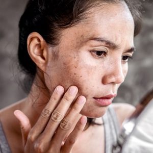 Mesotherapy for melasma price in Islamabad