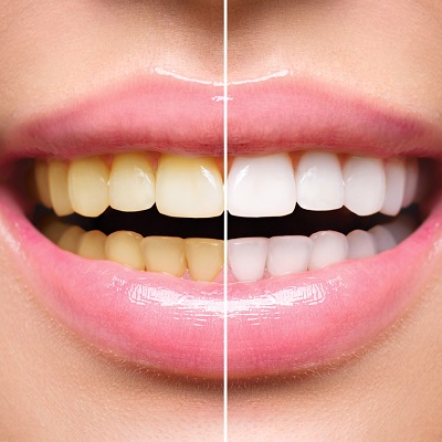 Nano Teeth Whitening | Skn cosmetic surgery