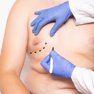 Before and After: Gynecomastia Surgery in Pakistan Transformations